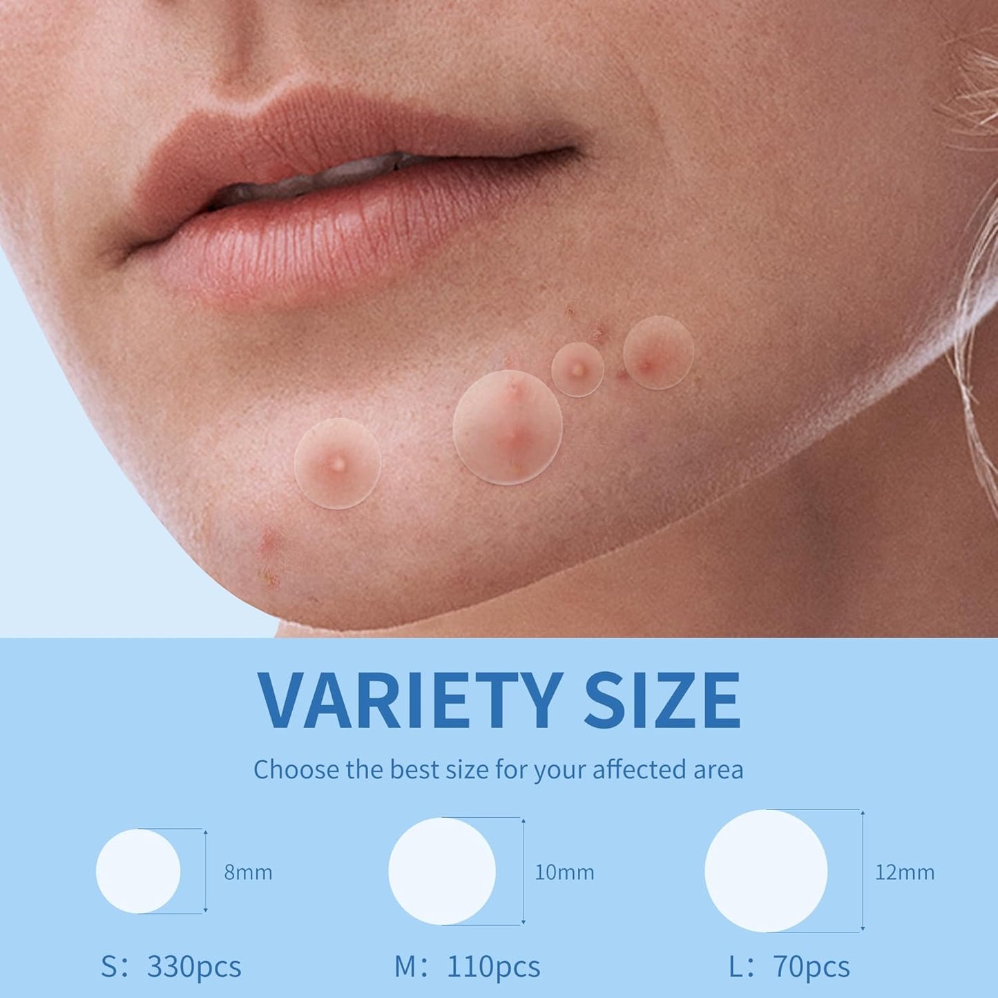 Hydrocolloid Acne Patches | 300 Count | Salicylic Acid & Tea Tree Oil