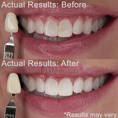 Teeth Whitening Kit | Fast Whitener Gel 44% Carbamide Peroxide | for Discolored, Yellow, Brown, Black, Coffee, Smoking, Intrinisic Deep Stains