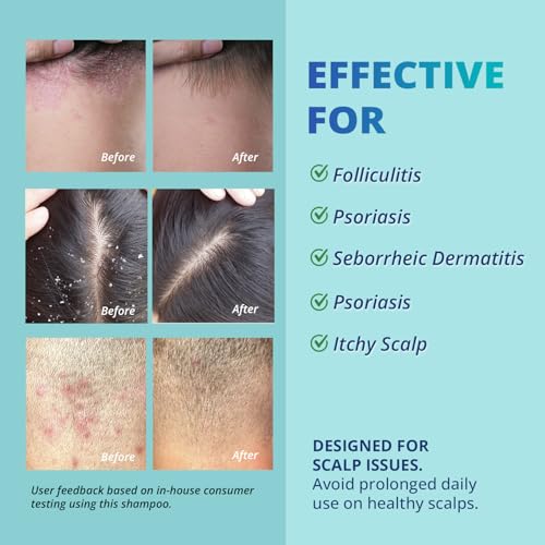 TAGRID Anti-Fungal Shampoo 300mL – Scalp Treatment for Psoriasis, Seborrheic Dermatitis, Folliculitis, Dandruff & Itchy Flaky Scalp – Soothing Plant-Based Formula for Men & Women