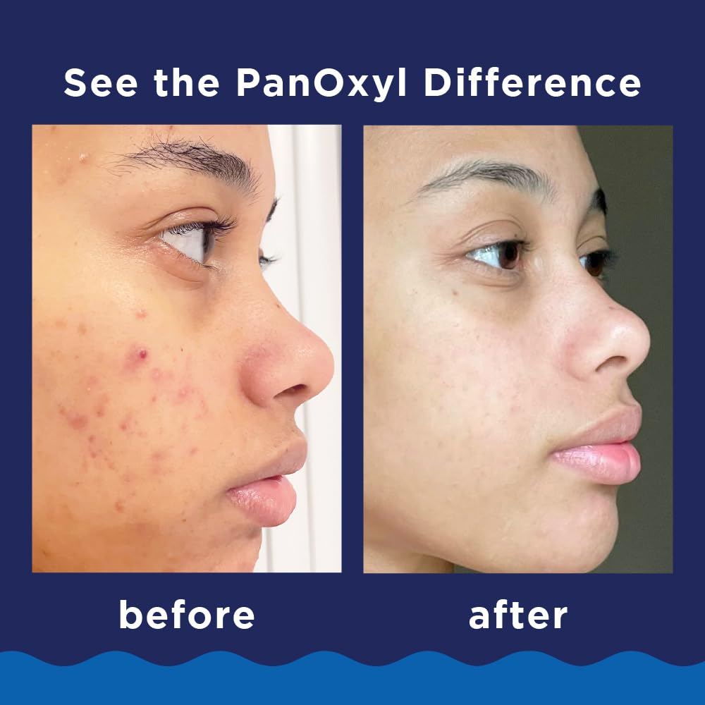 PanOxyl 10% Benzoyl Peroxide Acne Foaming Wash | Maximum Strength | 5.5 Oz