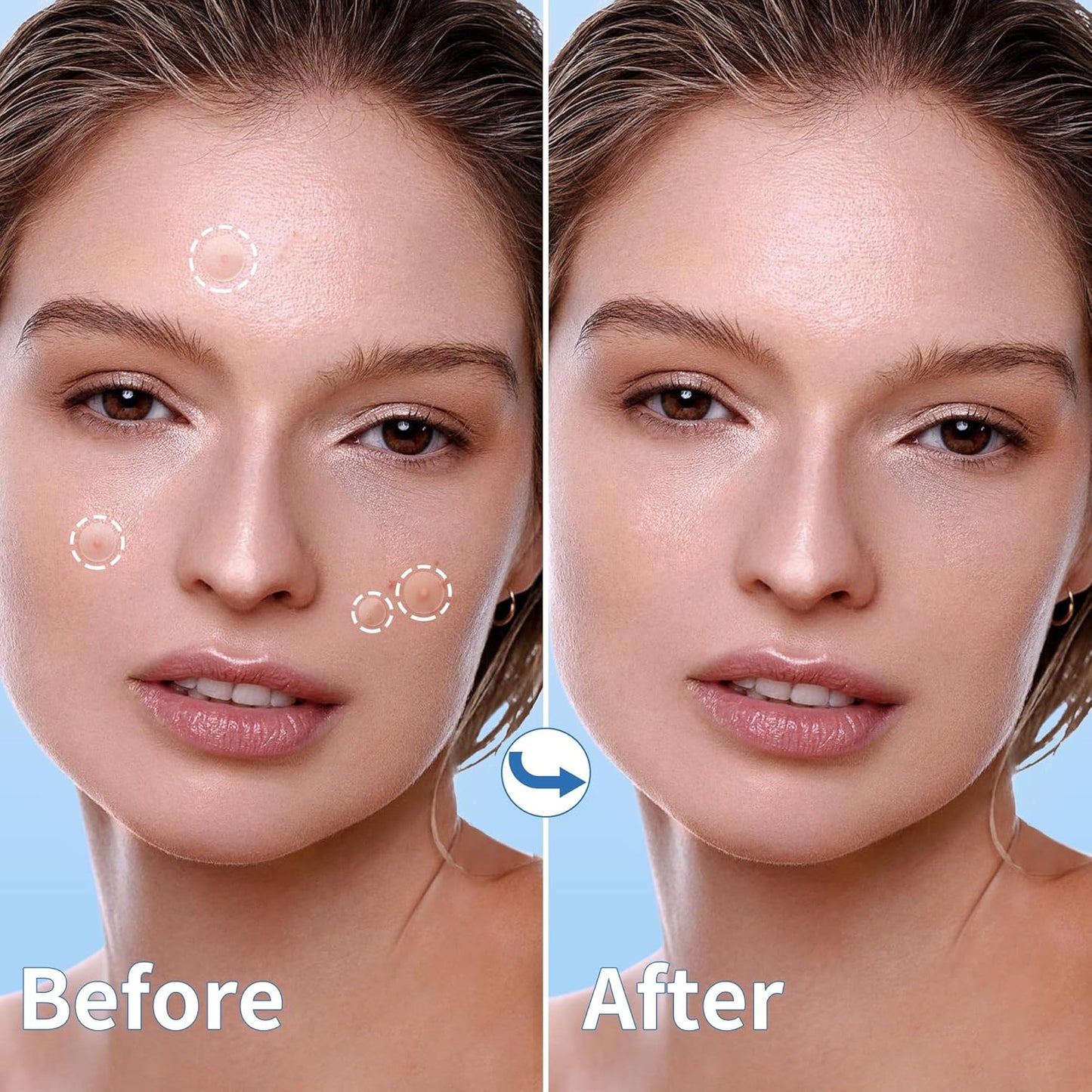 Hydrocolloid Acne Patches | 300 Count | Salicylic Acid & Tea Tree Oil