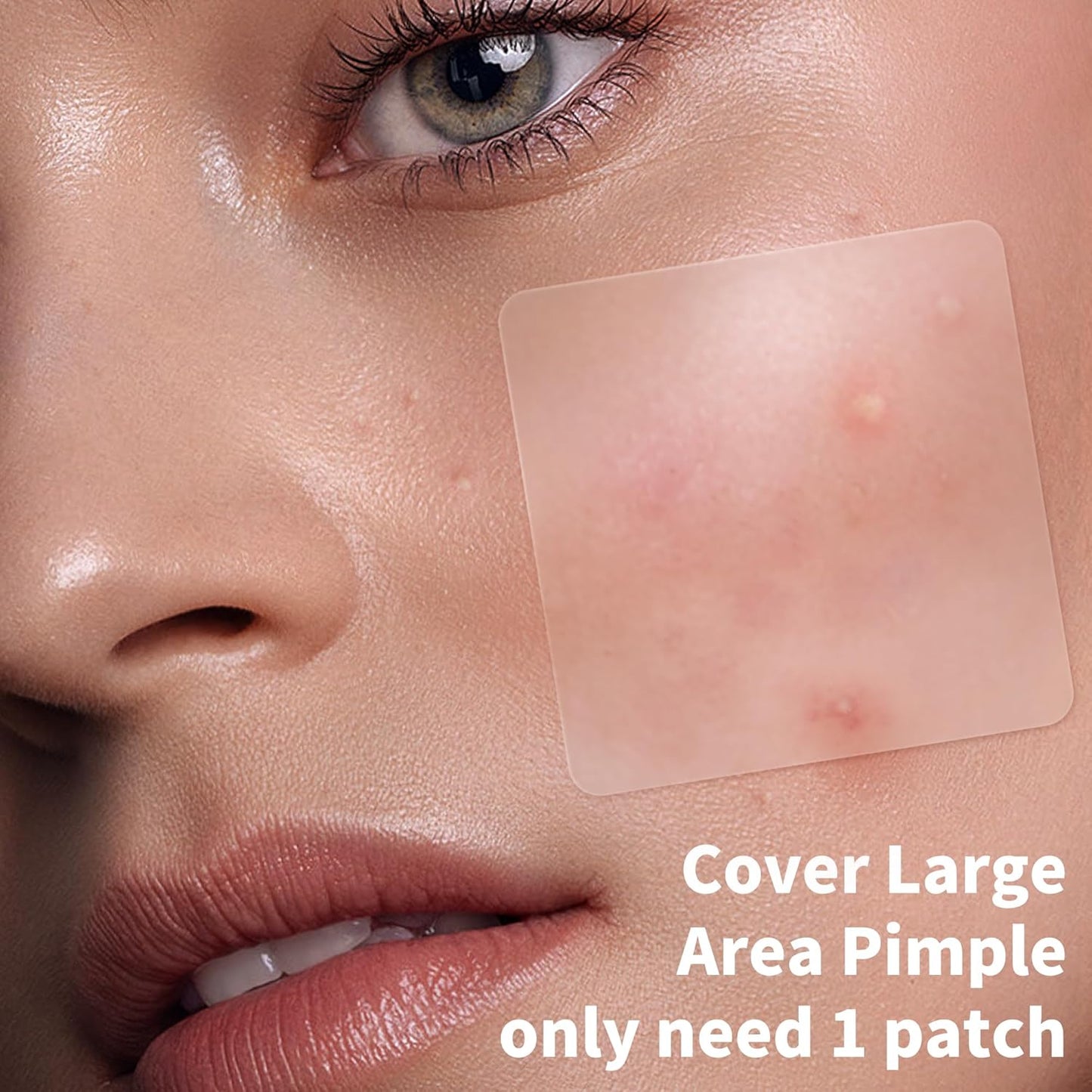 Large Hydrocolloid Acne Pimple Patches | 142 Count | 6 Sizes for Face & Body